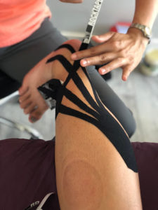 K-tape for swelling after ankle sprain